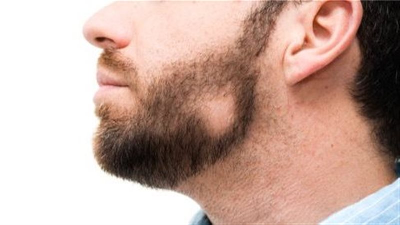  ثعلبة الذقن
