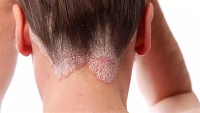حقائق خطيرة.. الصدفية قد تعرضك «للعدوى الجلدية» وهذه أسرار الوقاية