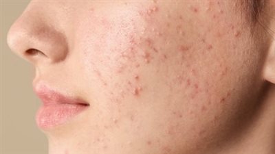 بمكونات آمنة وطبيعية.. تخلصي من حب الشباب في المنزل