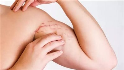 من أين تأتي علامات التمدد وكيف يمكن الحد منها طبيعيا؟
