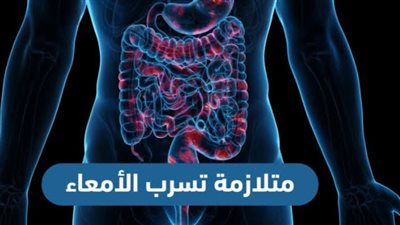5 علامات تكشف إصابتك بمتلازمة الأمعاء المتسربة لا تتجاهلها