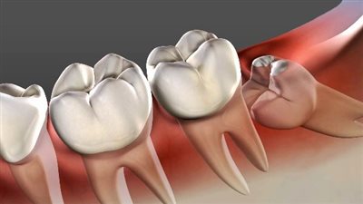 لماذا يسبب «ضرس العقل» الصداع المزمن؟.. تعرف على الأسباب وطرق الوقاية 
