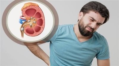 ألم الظهر يكشف أعراض «حصوات الكلى» وطرق الوقاية