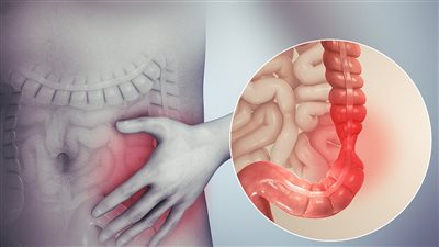 تجنب الألم.. نصائح فعالة للوقاية من التهابات القولون