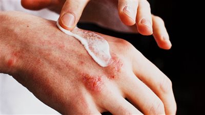 طرق طبيعية لتخفيف حكة الإكزيما والصدفية شتاء